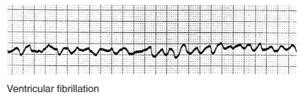 <p>“quivering” of myocardium; uncoordinated contraction of valves</p>