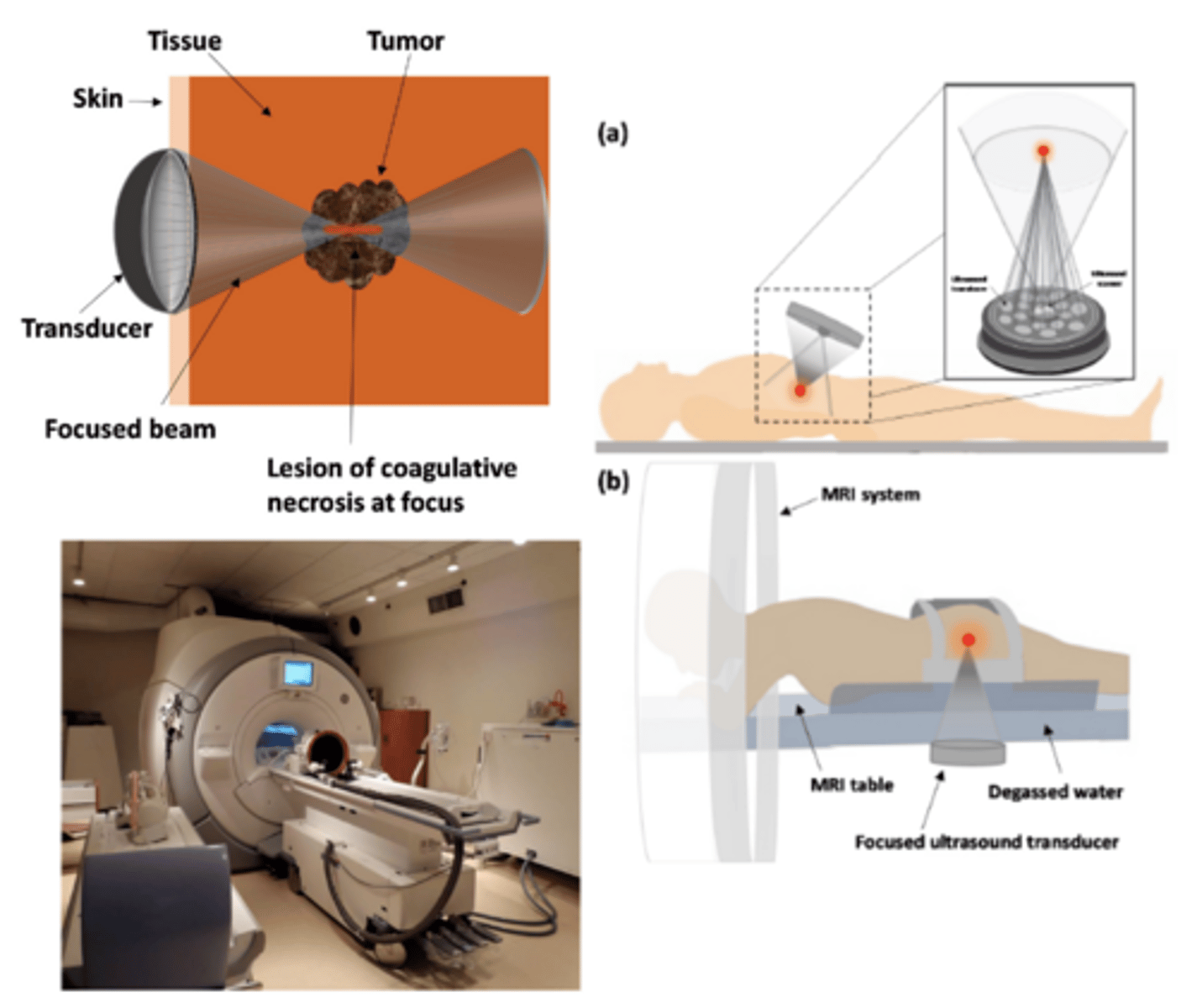 <p>Uses heat & cavitation from ultrasound to deliver therapeutic treatments</p><p>Performed under ultrasound or MRI guidance</p><p>Transducers designed and manipulated to have a very accurate focal spot - goal is to heat/cavitate tissues</p>