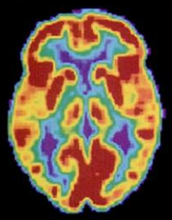 <p>an individual ingests a <span>mildly radioactive substance (tracer); a computer monitors the movement of the tracer and creates a rough map of active and inactive areas of the brain during a given behavior; PET scans show little detail, are unable to pinpoint events precisely in time, and require that the brain be exposed to radiation (replaced by fMRI); combined with CT, PET technology is still being used in certain contexts</span></p>