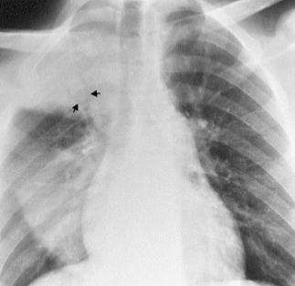 <p>Alveolar pneumonia </p>