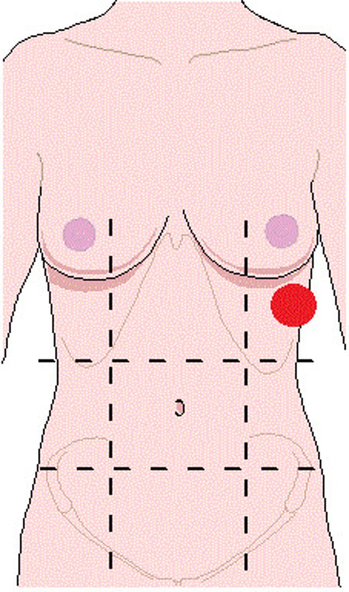 <p>Location:</p><p>Abdominal wall (anterior)</p><p>Description:</p><p>One of nine regions of abdominal cavity</p><p>Left upper lateral region</p><p>Contents include spleen and parts of stomach, large intestine, pancreas (tail), and left kidney</p>