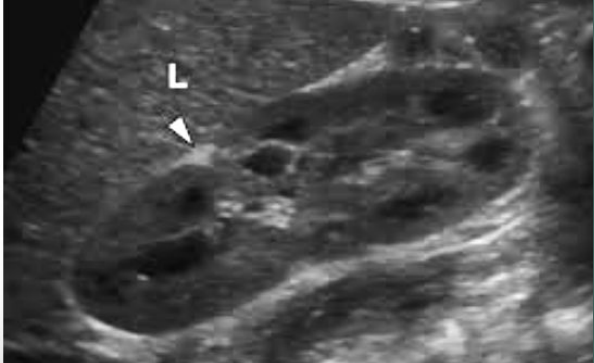 <p>A triangular, hyperechoic area </p>