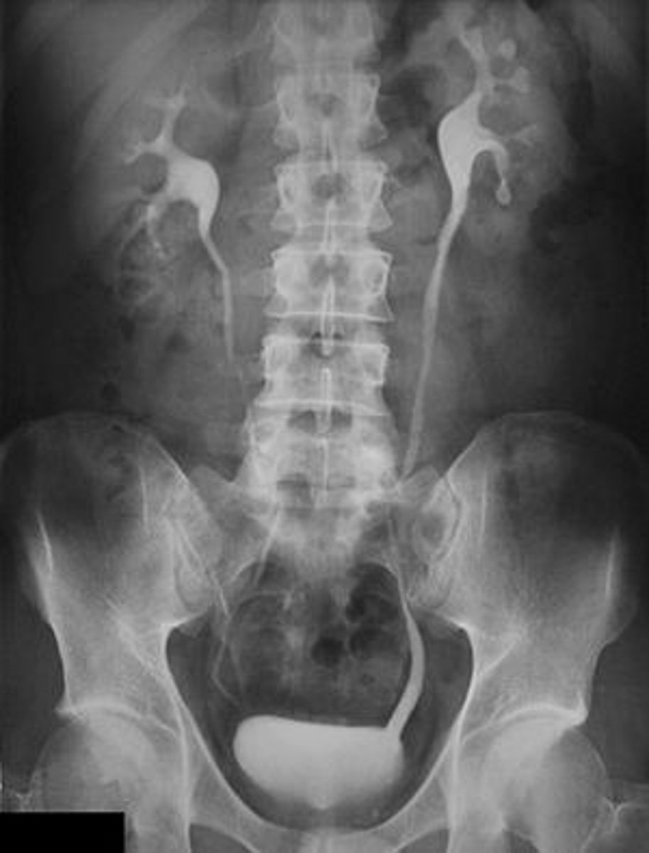 <p>Intravenous pyelogram</p>