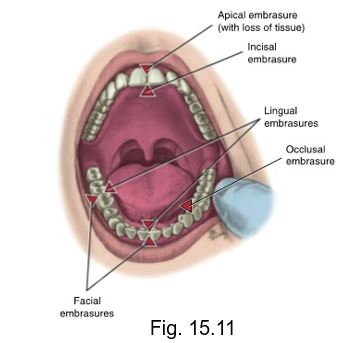 <ul><li><p>when two teeth in the same arch come into contact, the curvatures next to the contact areas form spaces considered embrasures. </p></li></ul><p></p>