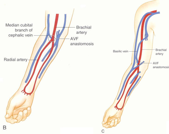 <p>Between brachial artery and cephalic vein at antecubital fossa or elbow </p>