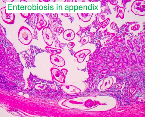 <p><span>Enterobiosis vermicularis penetrate through mucosa into deep layers → cause inflammation</span></p>