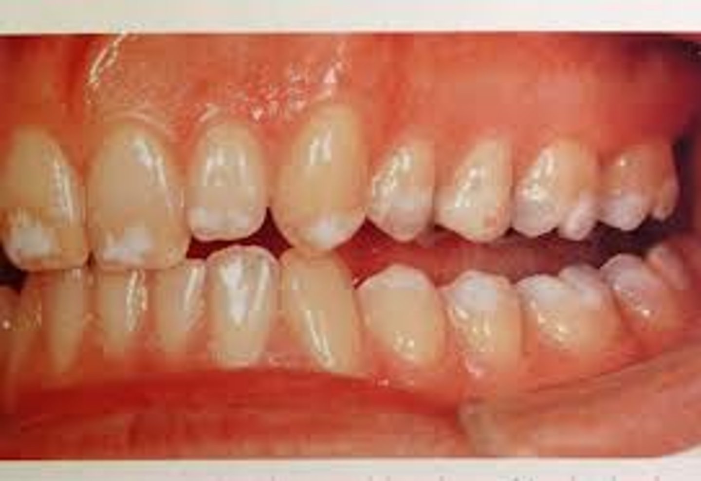 <p>Hereditary disorder of enamel formation.</p><p>-Clinically see enamel hypoplasia, pits, grooves, soft enamel, teeth can darken or be discolored. Dentin and Pulp appear normal.</p>