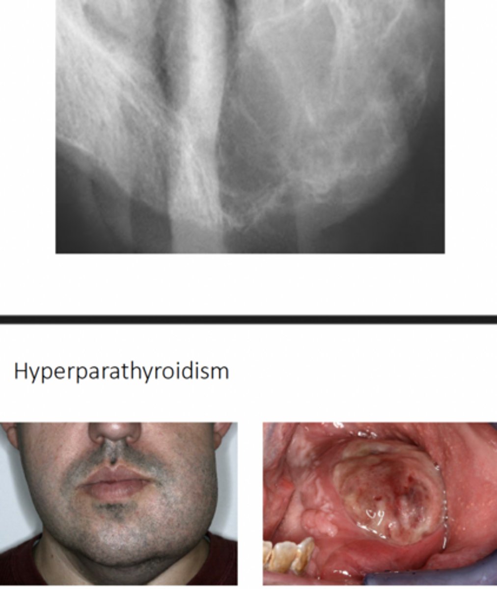<p>-oral manifestation of hyperparathyroidism</p><p>-commonly affect mandible + clavicle, ribs, pelvis</p><p>-dark-red tissue color due to abundant hemorrhage and hemosiderin deposition</p><p>-well-demarcated uni or multi-locular radiolucencies</p><p>-usually multiple (may be solitary)</p><p>-long standing lesions may cause expansion</p>