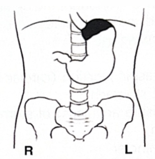 <p>White is barium: what position is the patient in? </p>