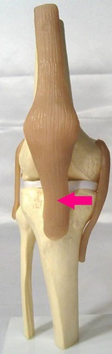 <p>Is the lower portion of the ligament that attaches to the patella ( from patella to tibia)</p>