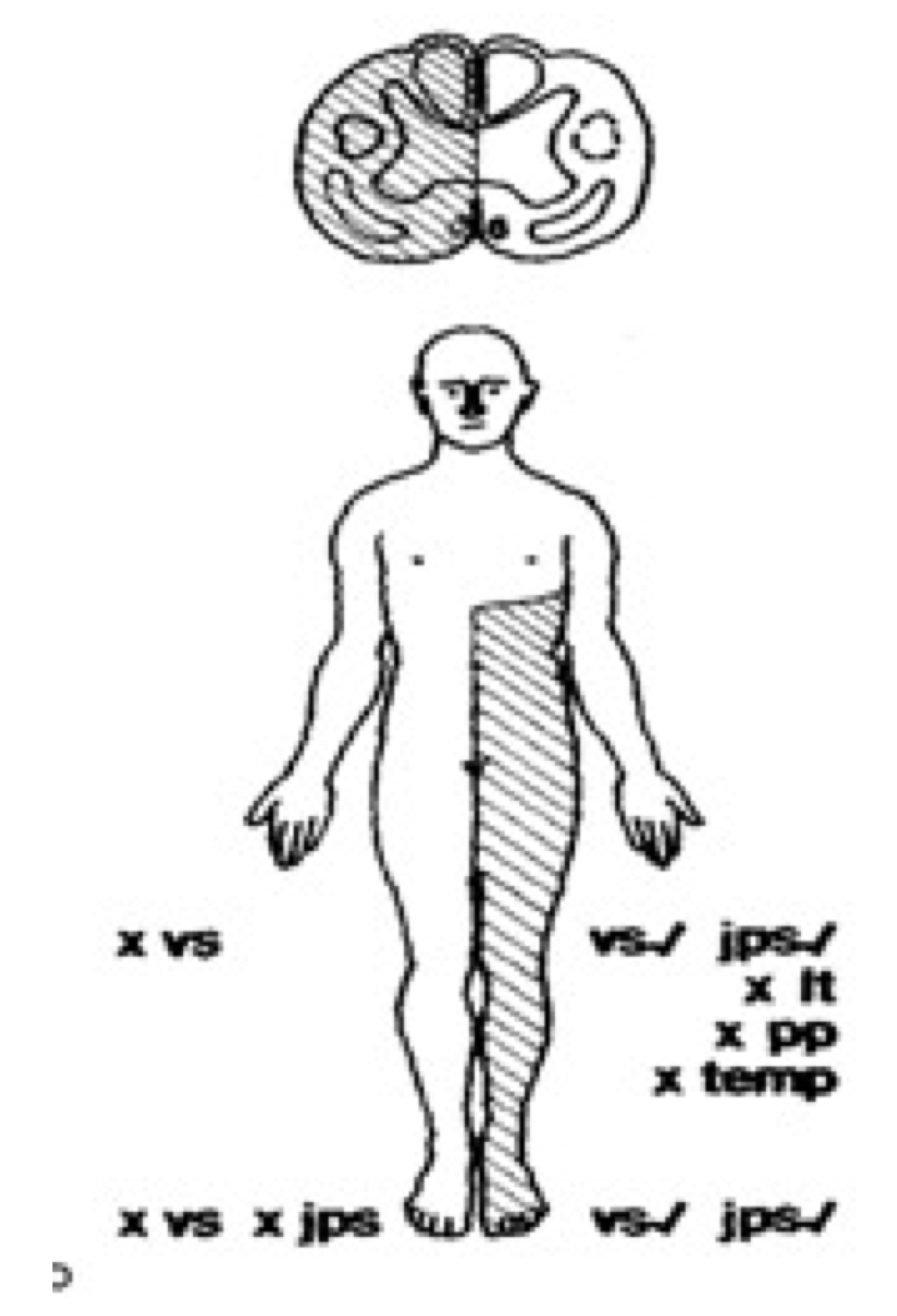 <p>Lesão hemissecção medula espinhal:</p><ul><li><p><strong>ipsilateral</strong>: paralisia motora + perda sensibilidade propriocetiva e vibratória (cordão posterior)</p></li><li><p><strong>contralateral</strong>: perda sensibilidade dolorosa e térmica (feixe espinotalâmico lateral)</p></li></ul><p></p>