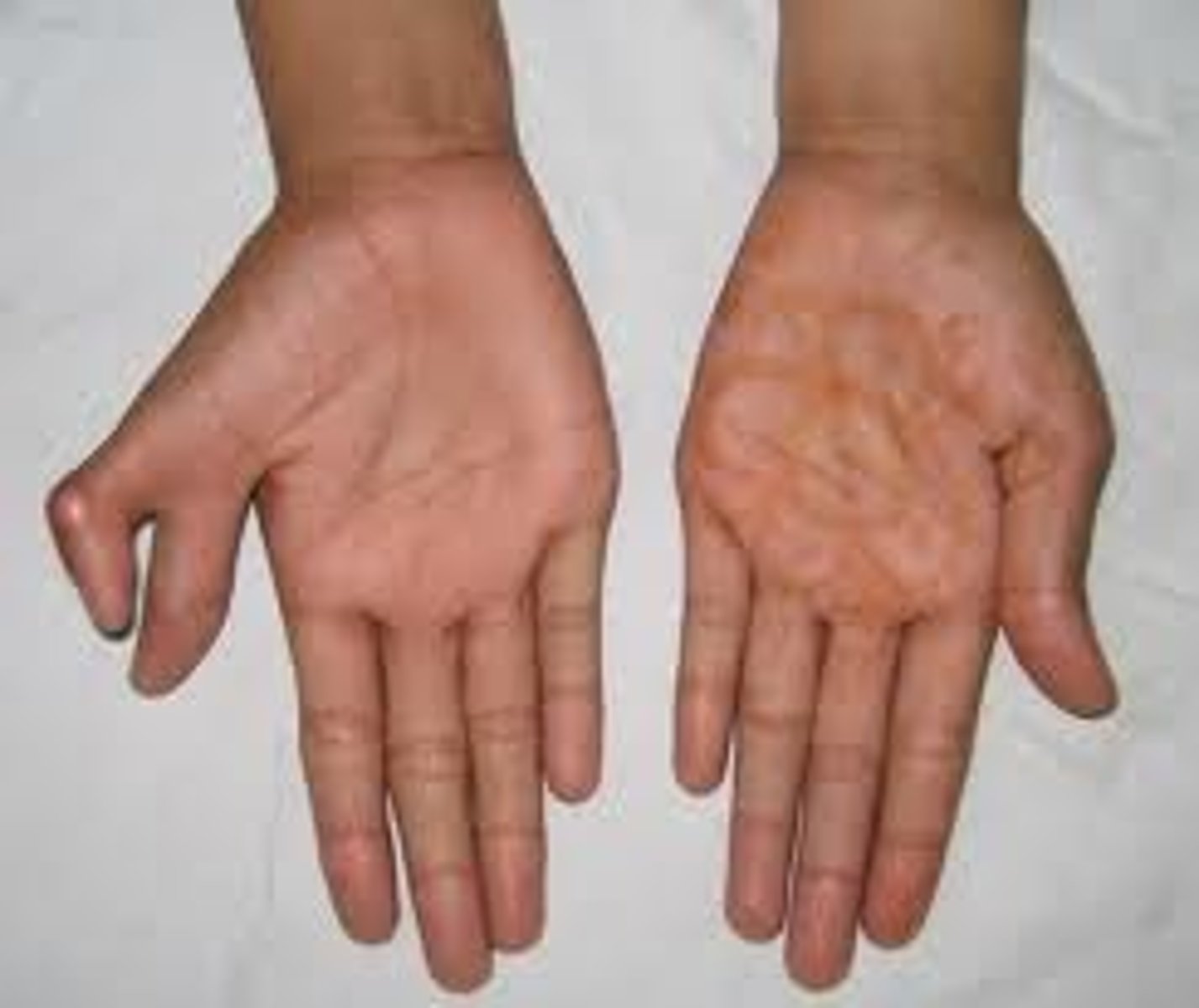 <p>an inherited disorder producing extra fingers or toes caused by a dominant allele</p>