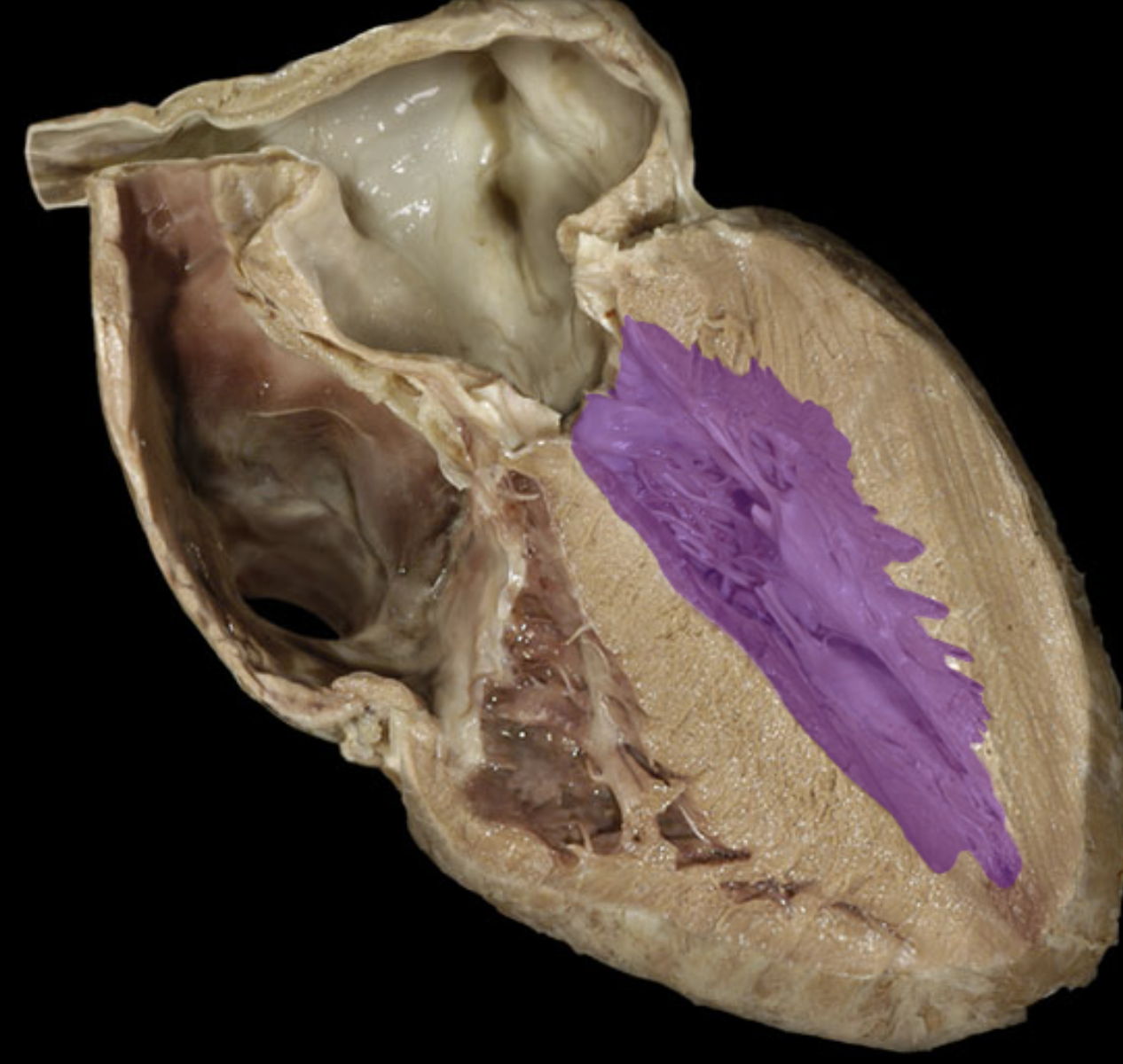 <p>Left ventricle</p>
