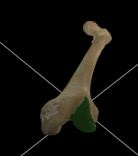 <p>Grote knobbel aan de laterale zijde voor articulatie met de tibia.</p>