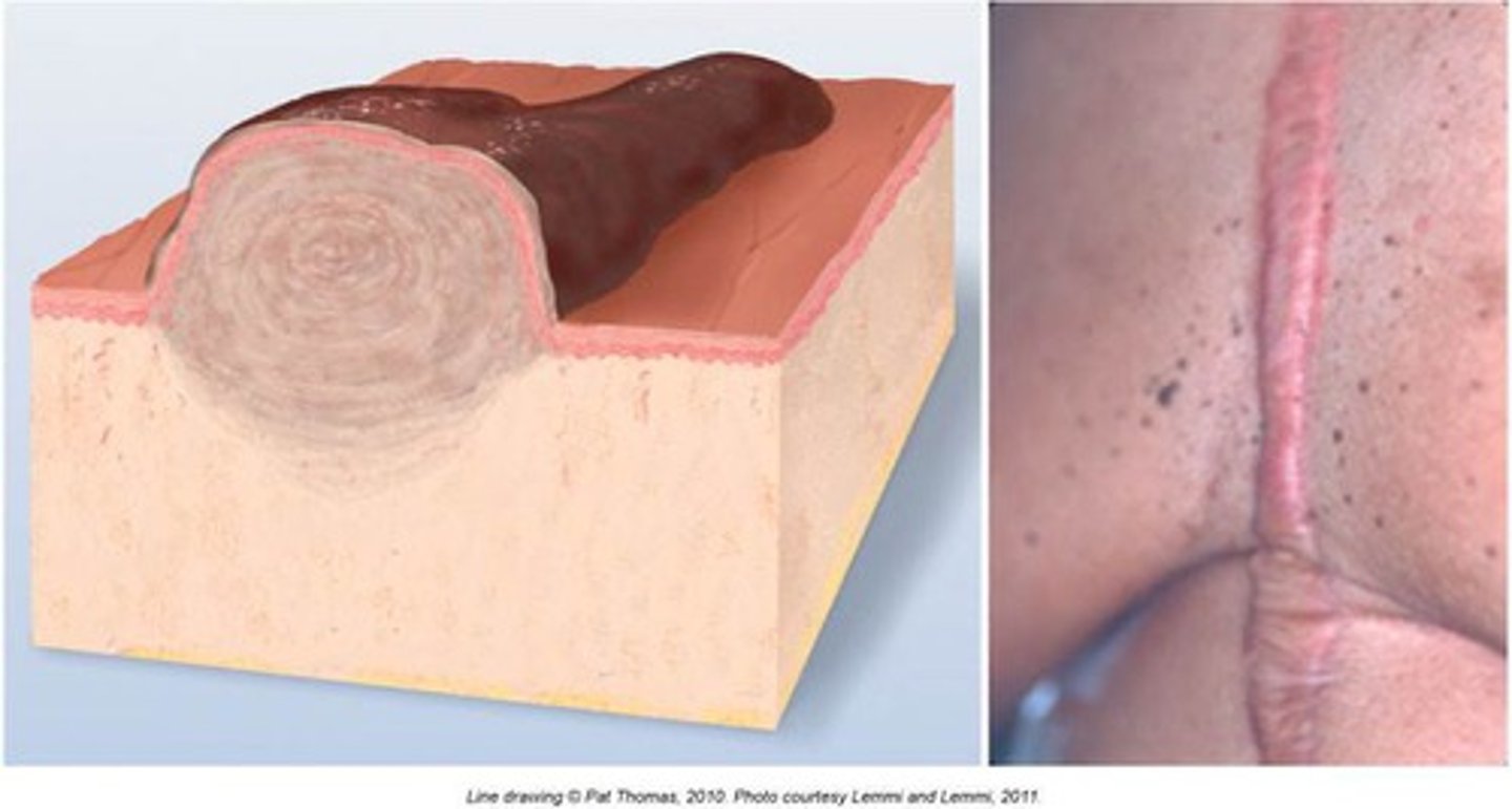 <p>benign excess of scar tissue beyond sites of original injury, more common in Black, Latino, and Asian</p>