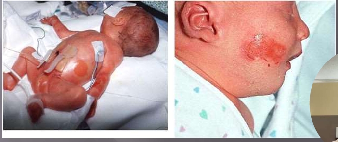 <p>Medical Adhesive Related Skin Injury (MARSI)</p>