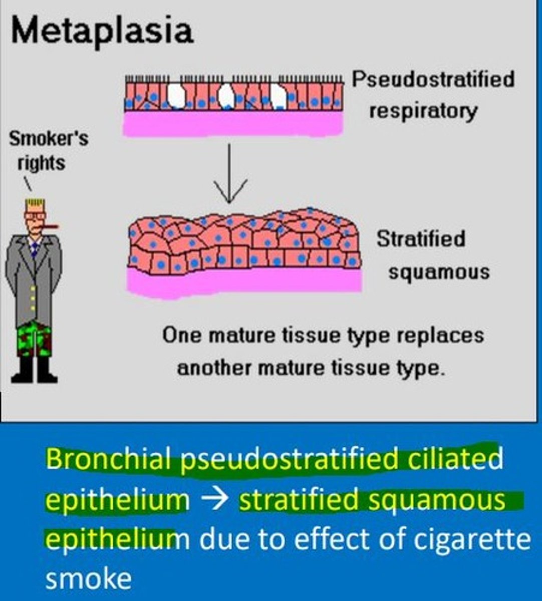 <p>Transformation of bronchial pseudostratified ciliated columnar epithelium to stratified squamous epithelium occurs due to the effect of cigarette smoking.</p><p>This means that the squamous epithelium doesn't produce cleansing mucus and lacks cilia to move it along. This makes the smoker more vulnerable to respiratory infections.</p>