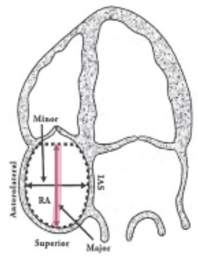 <p>Longitudinal measurement from TV annulus parallel to the IVS to superior right atrial wall</p>