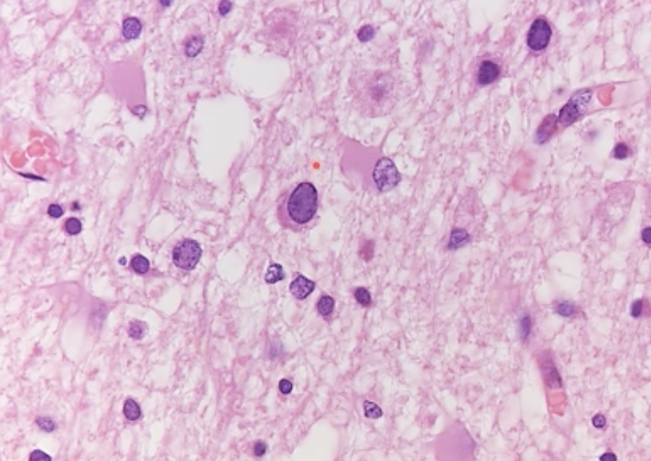 The giant oligodendricite in the middle by the pointer has been infected by the JC virus. Astrocytes are also seen here because they are very actively trying to get rid of the infection 