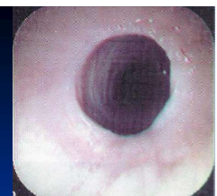 <ul><li><p>usually the <strong>result of acute obstruction </strong></p><ul><li><p>also external trauma, reflux esophagitis, congenital </p></li></ul></li><li><p><strong>signs are recurrent obstruction </strong></p><ul><li><p>diagnosis with endoscopy, contrast radiography </p></li></ul></li><li><p>bougienage techniques, endoscopic and other </p></li><li><p>surgical techniques include </p><ul><li><p>esophagomyotomy, partial or complete resection - anastomosis and patch grafting </p></li></ul></li><li><p><strong>prevention is </strong></p><ul><li><p><strong>diligent management of primary obstruction </strong>thorough post-obstruction evaluation and prolonged feeding of low-bulk diet when indicated </p></li></ul></li></ul><p></p>