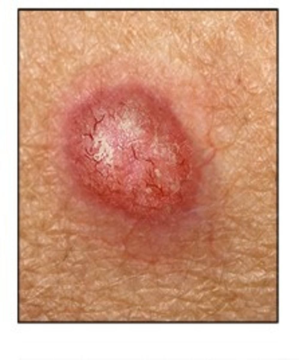 <p>least malignant and most common skin cancer</p><p>curable 99% of the time</p>