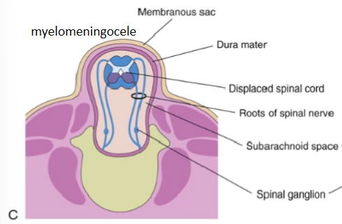 <ul><li><p><span>Meninges and nervous tissue protrude</span></p></li><li><p><span>Nervous roots gets stretched excessively</span></p></li><li><p><span>Neural defects are always present</span></p></li></ul>