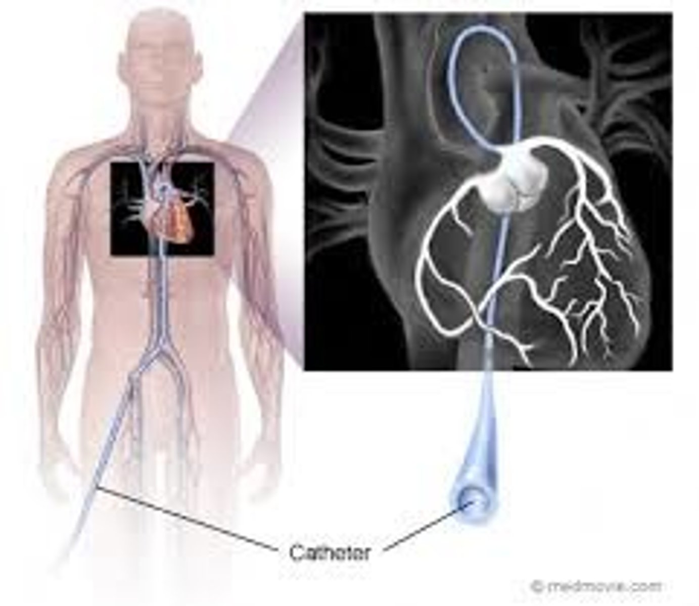 <p>can view and open up blocked coronary arteries</p>