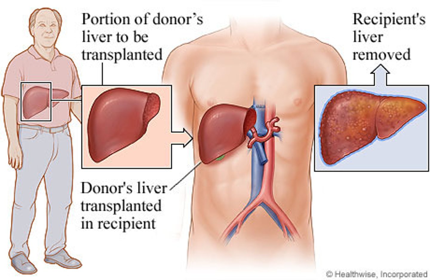 <p>- lobe of liver can be donated (only once in a lifetime) </p><p>- liver regenerates/grows back to full function for the receiver and donor</p><p>- best candidates: end stage liver disease or primary liver cancer</p><p>- pts not considered: active alcoholics, active substance abusers, those w/ metastatic tumors</p>