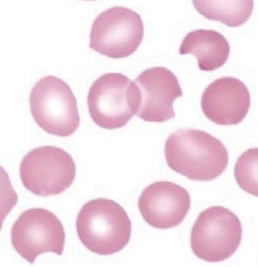 <p><span style="font-family: "Times New Roman", serif">RBCs with a "bite-like" removal of hemoglobin; formed when spleen removes Heinz bodies; associated with G6PD deficiency.</span></p>