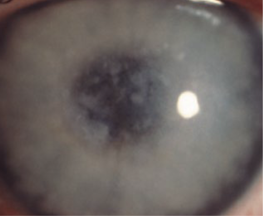 <ul><li><p>stromal dystrophy&nbsp;</p></li><li><p>autosomal <em>recessive</em></p></li><li><p><span>Common in Iceland and Saudi Arabia</span></p></li><li><p><span><strong>Onset</strong>: first decade</span></p></li><li><p><span><strong>Symptoms</strong>:</span></p><ul><li><p><span>Blurred vision (significantly in 2nd-3rd decade)</span></p></li><li><p><span>pain w/ RCE</span></p></li></ul></li><li><p><span><strong>Presentation</strong>: deposits made up of mucopolysaccharides</span></p><ul><li><p><span>Ill defined gray-white deposits that start in the central cornea and will migrate to limbus</span></p></li><li><p><span>Located in the anterior and posterior stroma</span></p></li><li><p><span>Entire cornea will appear cloudy as corneal collage fibrils are re-arranged</span></p><ul><li><p><span>Eventually the collagen fibers will be replaced by fibrotic tissue and the cornea will thin</span></p></li></ul></li><li><p><span>Decrease corneal sensitivity</span></p></li><li><p><span>Corneal edema will develop late in the disease process due to endothelial dysfunction</span></p></li></ul></li><li><p><span><strong>Complications</strong>: blurred vision, recurrent corneal erosions (uncommon)</span></p></li><li><p><span><strong>Treatment</strong></span></p><ul><li><p>tx for RCE</p></li><li><p><span>Penetrating keratoplasty: recurrence is common</span></p></li></ul></li></ul><p></p>