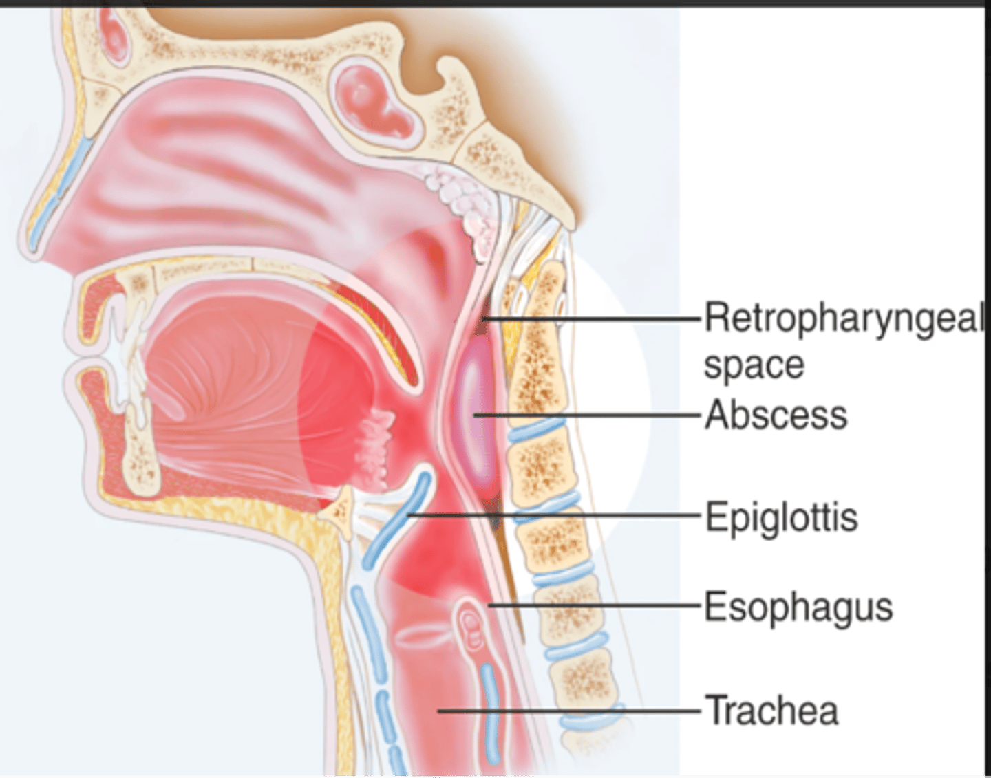 <p>- A life-threatening deep neck space infection that has the potential to occlude the airway</p><p>- More common in boys, highest incidence is children under 5</p><p>- Strep A, Staph aureus</p><p>- Predisposing factors tonsillitis, pharyngitis, dental infection</p>
