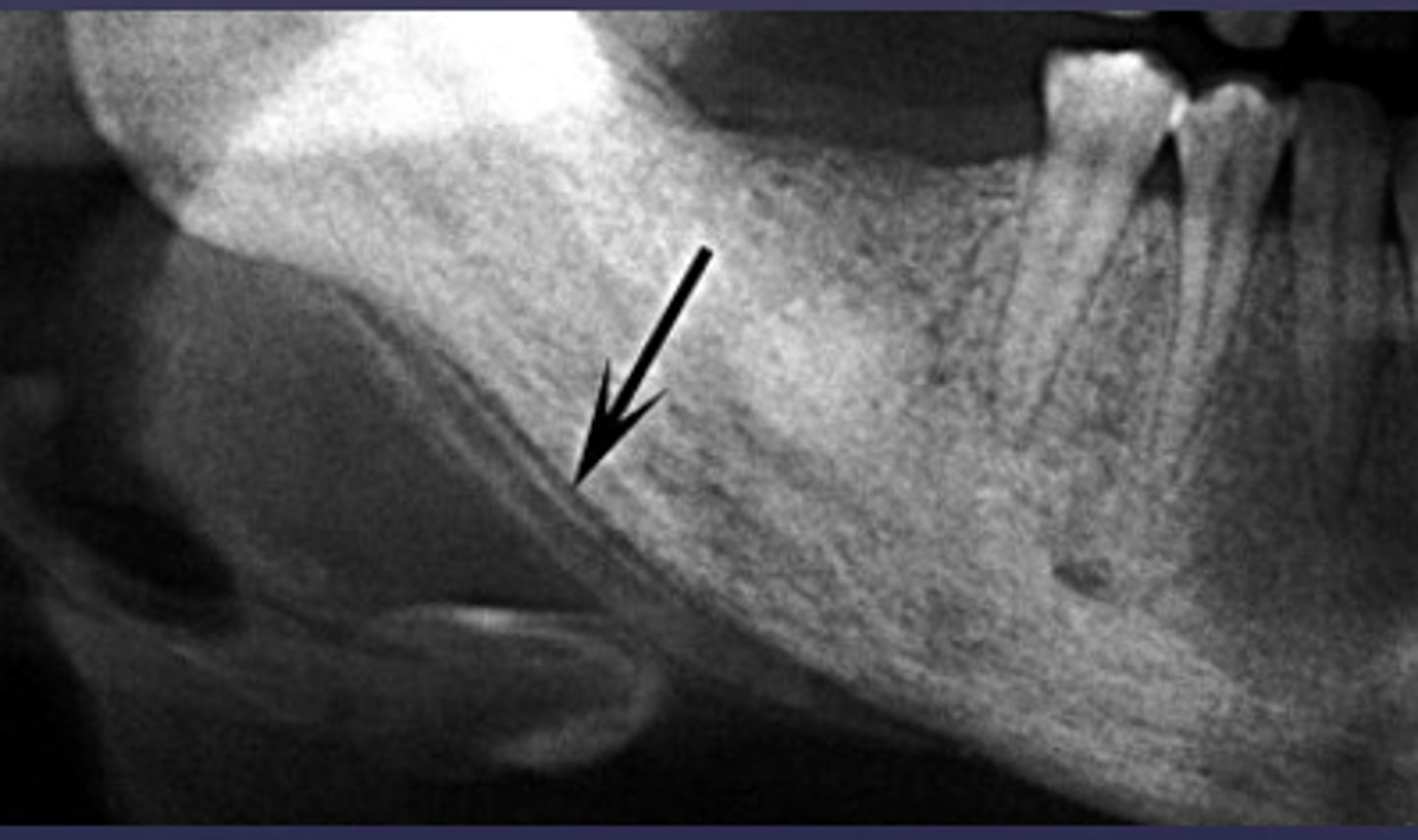 <p>A radiograph of the mandible shows concentric layers of new bone formation parallel to the cortex, producing an "onion-skin" appearance. What is the diagnosis?</p>