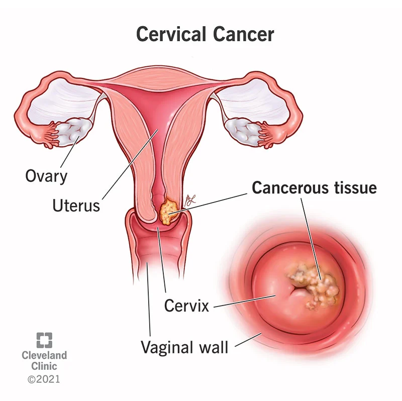 <p>Cervical cancer</p>