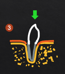 <p>unlikely to create new attachment; may create deeper pocket&nbsp;</p>