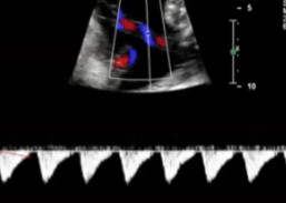 <p>A sonographer dopplered the umbilical artery and this doppler waveform was seen. </p><ol><li><p>Describe the waveform.</p></li><li><p>Based on the findings, would this be normal or abnormal?</p></li></ol><p></p>