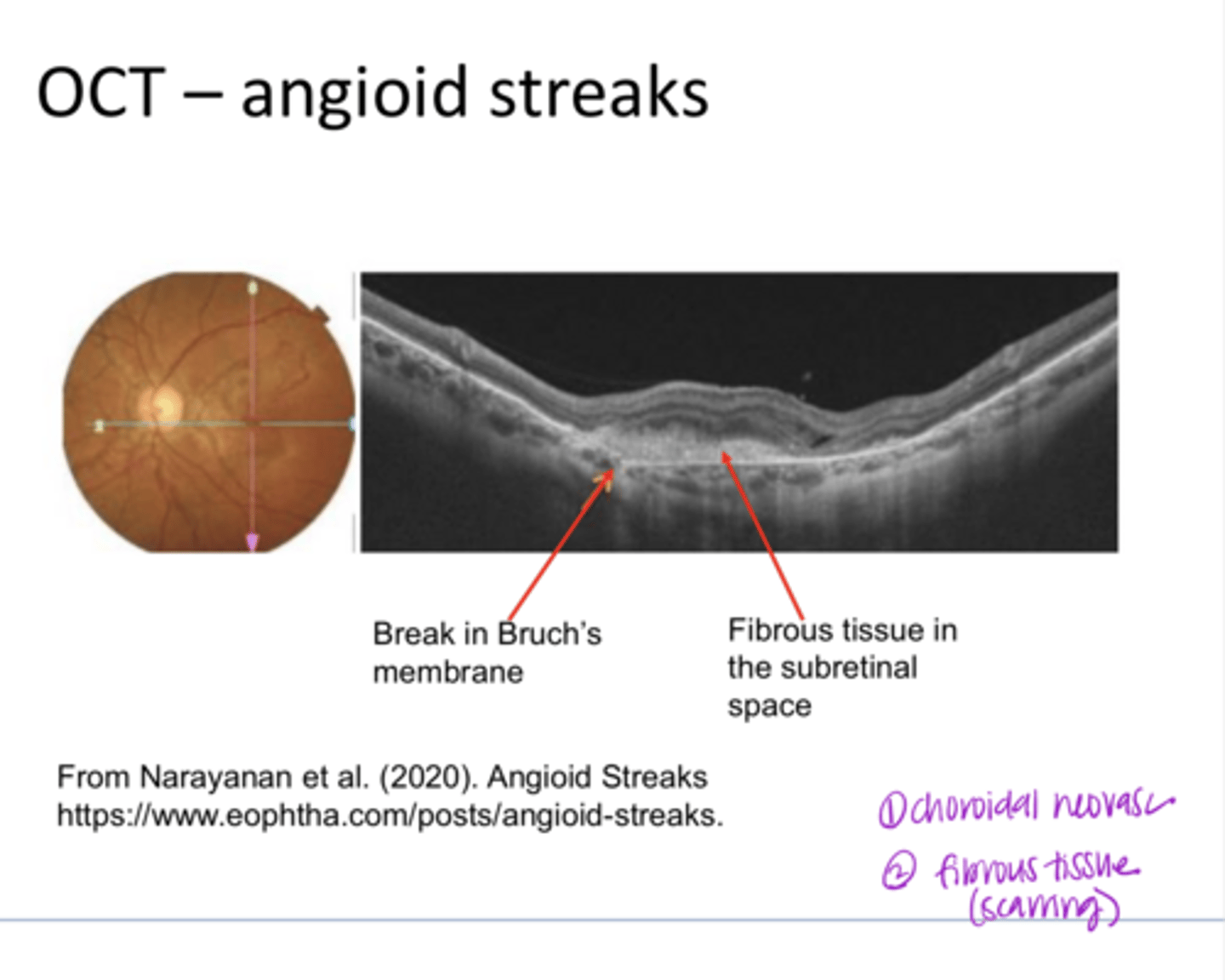 <p>OCT Angioid Streaks (Pic)</p>