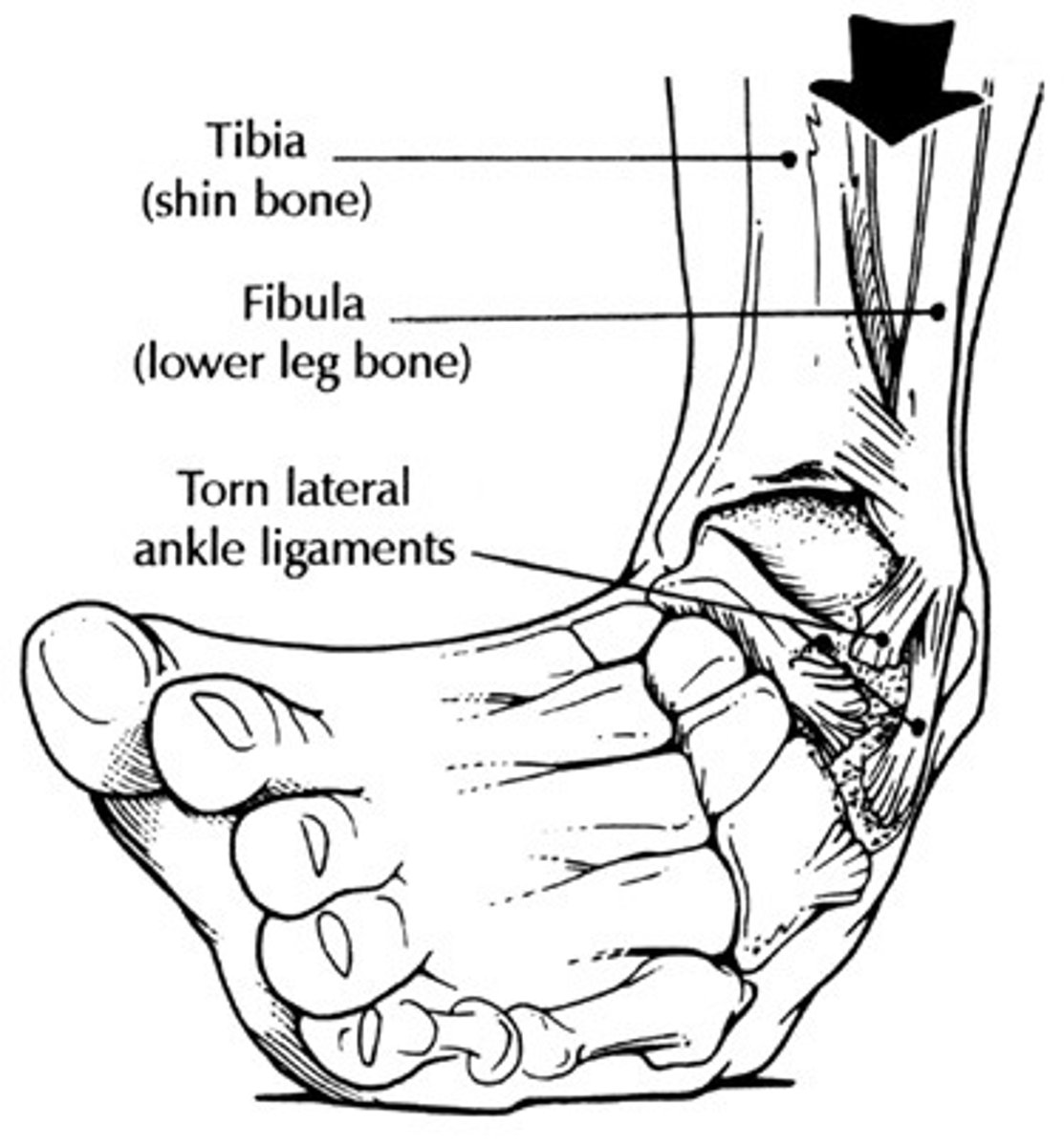 <p>injury in which the ligament in a joint is stretched too far or torn</p>
