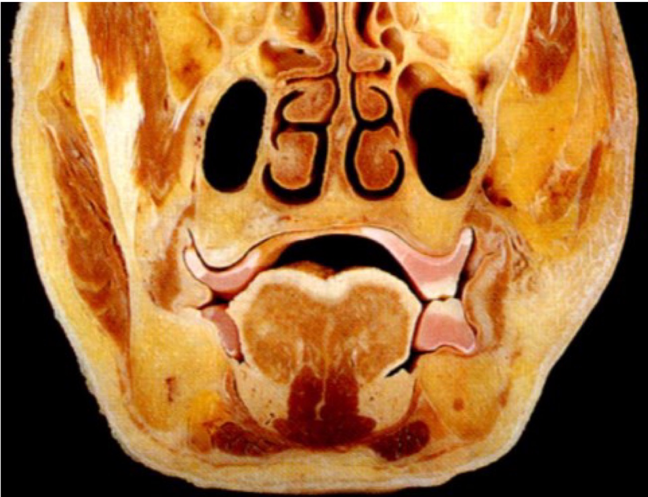 <p>Quels muscles sont visibles en coupe frontale de la cavité buccale autour de la mandibule ? (image)</p>