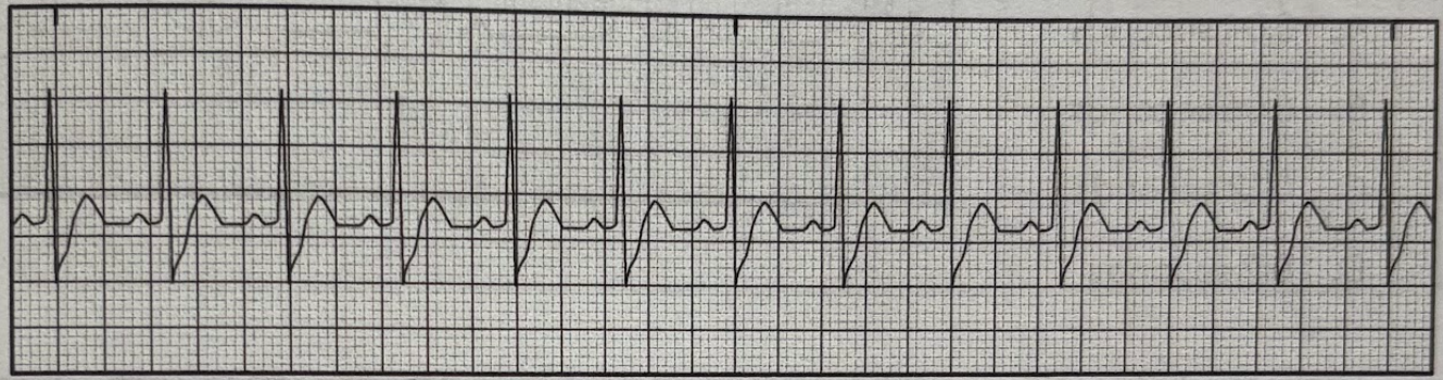 <p>Using the 6-second method, determine the patient’s heart rate from the EKG tracing.</p><p>A. 60/min</p><p>B. 80/min</p><p>C. 120/min</p><p>D. 140/min</p>