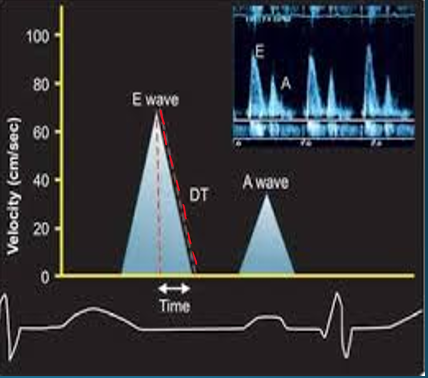 <p>time interval from E peak to projected baseline</p><p>indicates duration of time it takes to equalize pressure difference between LA and LV</p>