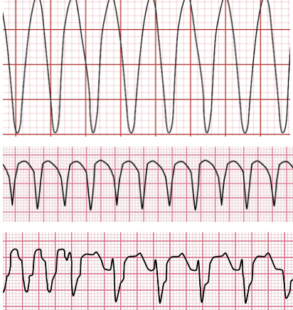 <p>Identify the rhythm! Discuss nursing and collaborative care</p>
