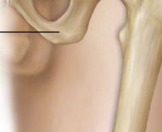 <p>posterior spine for muscle attachment in lower limb</p>