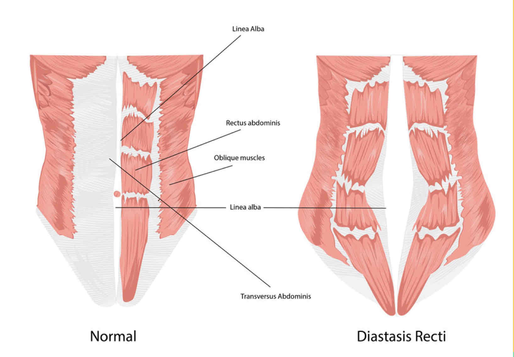<p>Diastasis Recti</p>