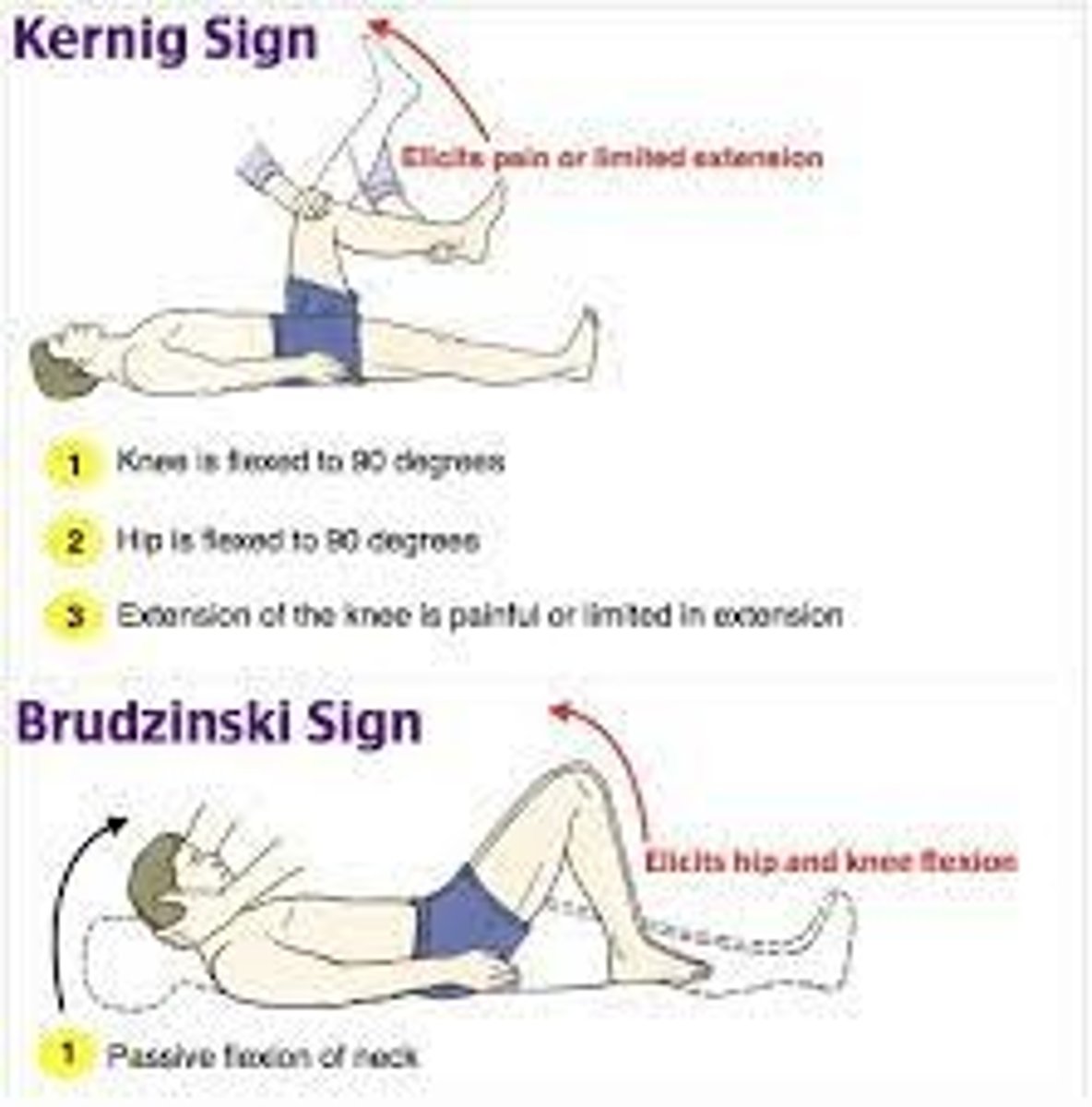 <p>Pain on flexion of the hip and knee.</p><p>Kernig’s sign is positive if pain occurs on flexion of the hip and knee. The Brudzinski reflex is positive if pain occurs on flexion of the head and neck onto the chest</p>