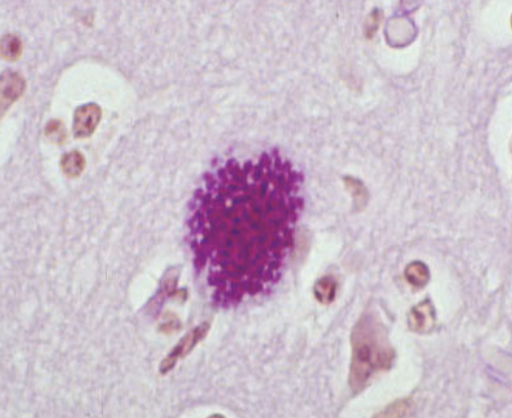 <p>What pathology is this and what parasite is it indicative of?</p>
