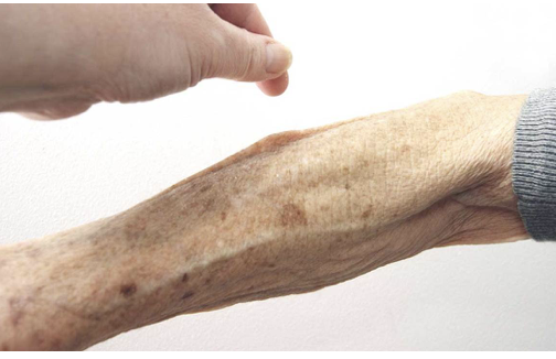 <p><span>How would you document this skin condition?</span></p><p></p>
