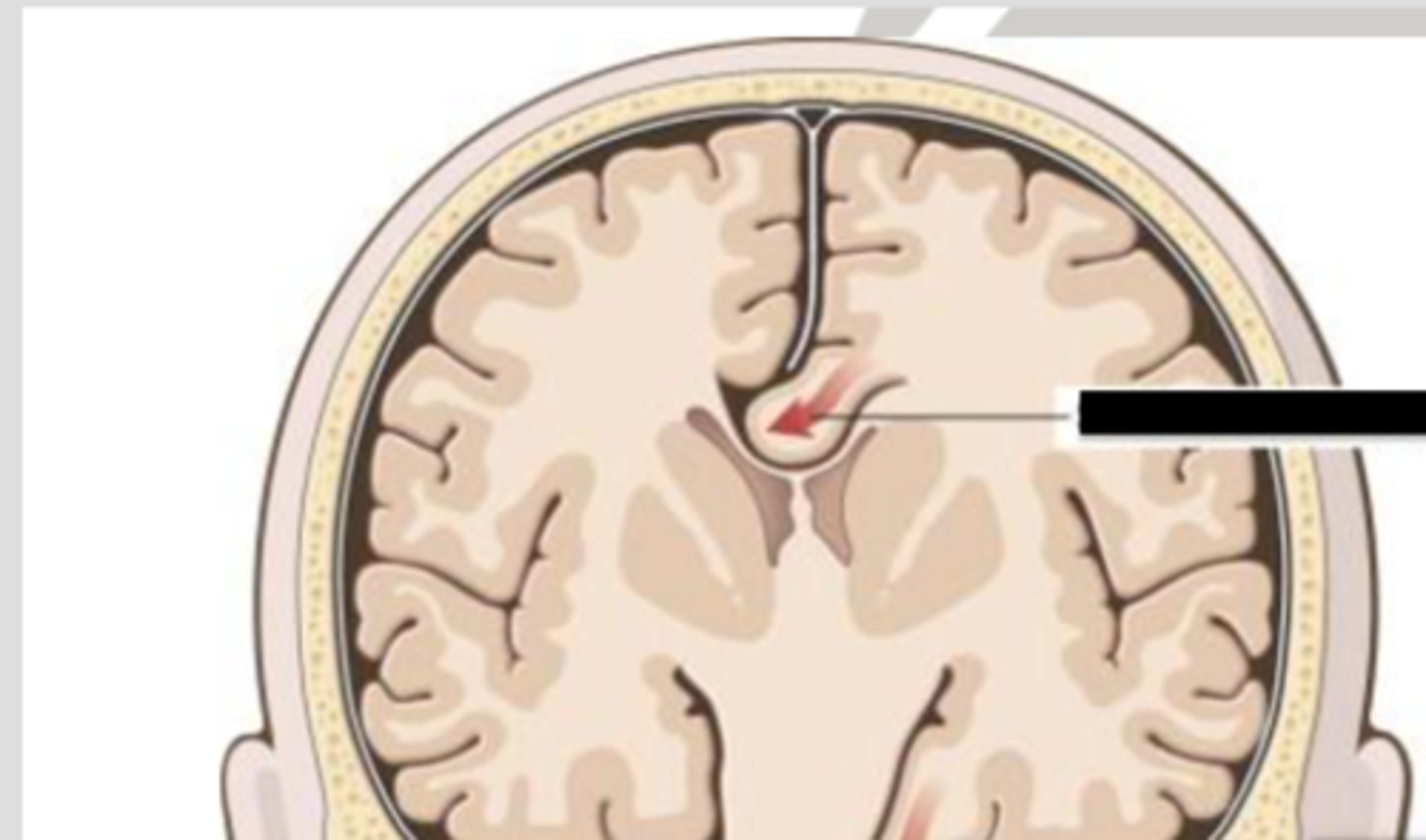 <p>herniation of the brain where the medial frontal lobe shifts under the falx cerebri</p>