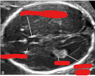 <p>lateral ventricle</p>