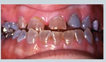 <p>abnormal colour of teeth - what causes t<strong>ranslucent brown/purple teeth </strong>?</p>