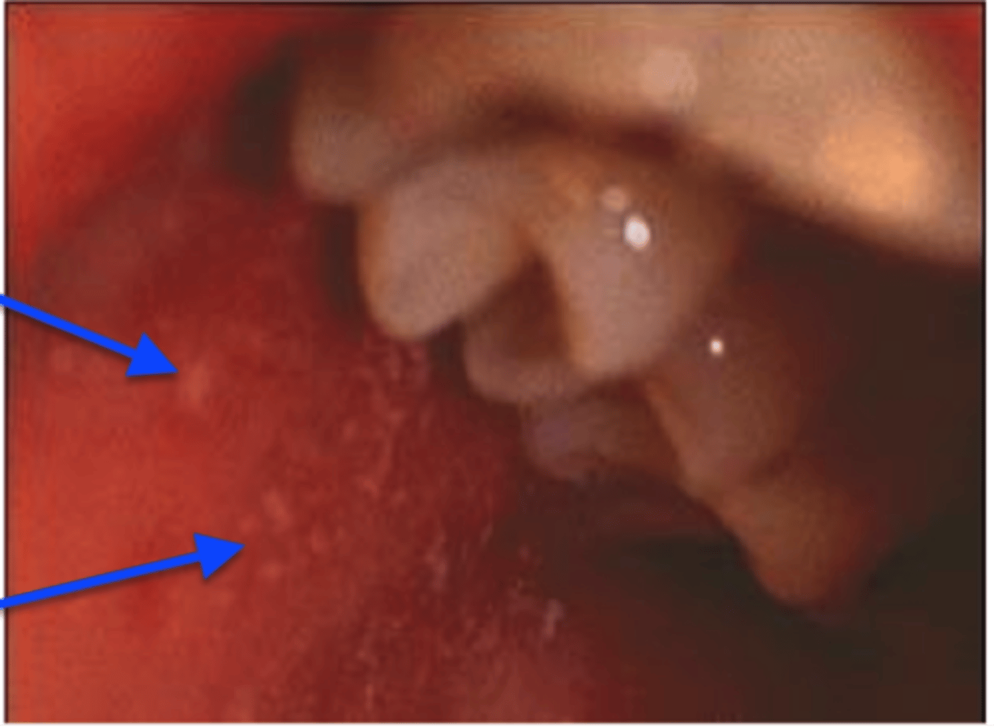 <p>Risk factor: unvaccinated</p><p>Symptoms: Koplik spots on buccal mucosa (white lesions with surrounding redness), a rash that starts at hairline, spreads down, accompanied by a higher fever (104 degrees)</p><p>-3 C's: cough, coryza (runny nose), conjunctivitis)</p>